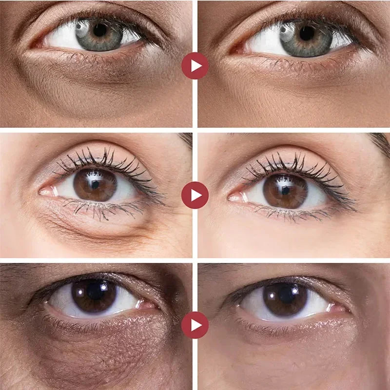 Creme Removedor de Grânulos de Gordura para Olhos Remove Olheiras