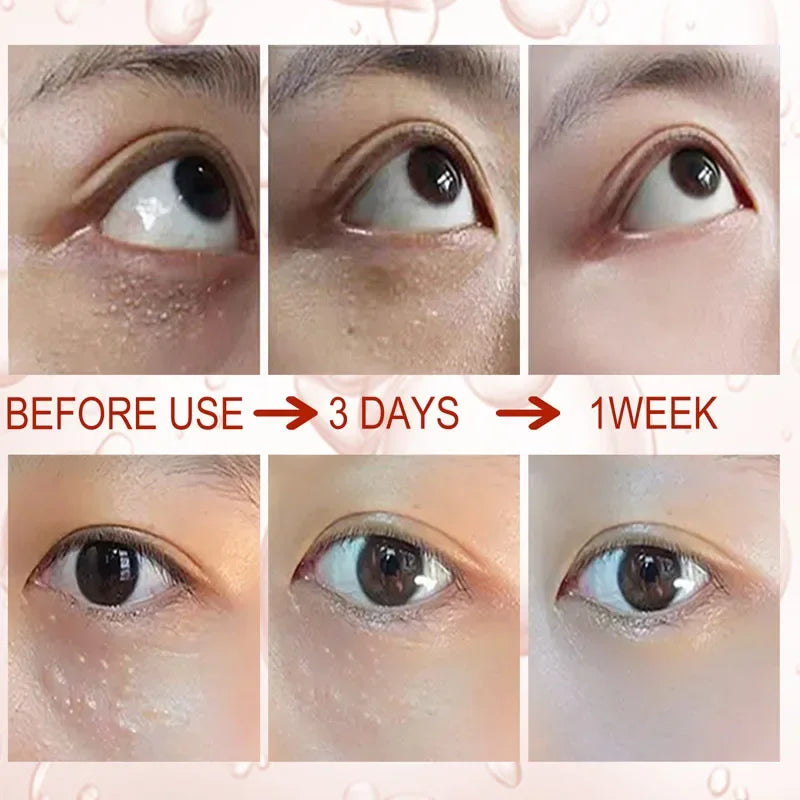 Creme Removedor de Grânulos de Gordura para Olhos Remove Olheiras